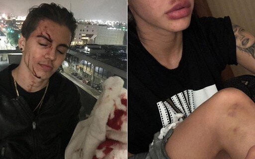Biel A Fazenda 2020 e Duda Castro compartilham fotos de seus ferimentos após briga
